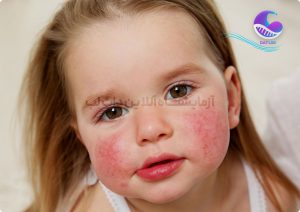 آلرژی در کودکان - دات لب